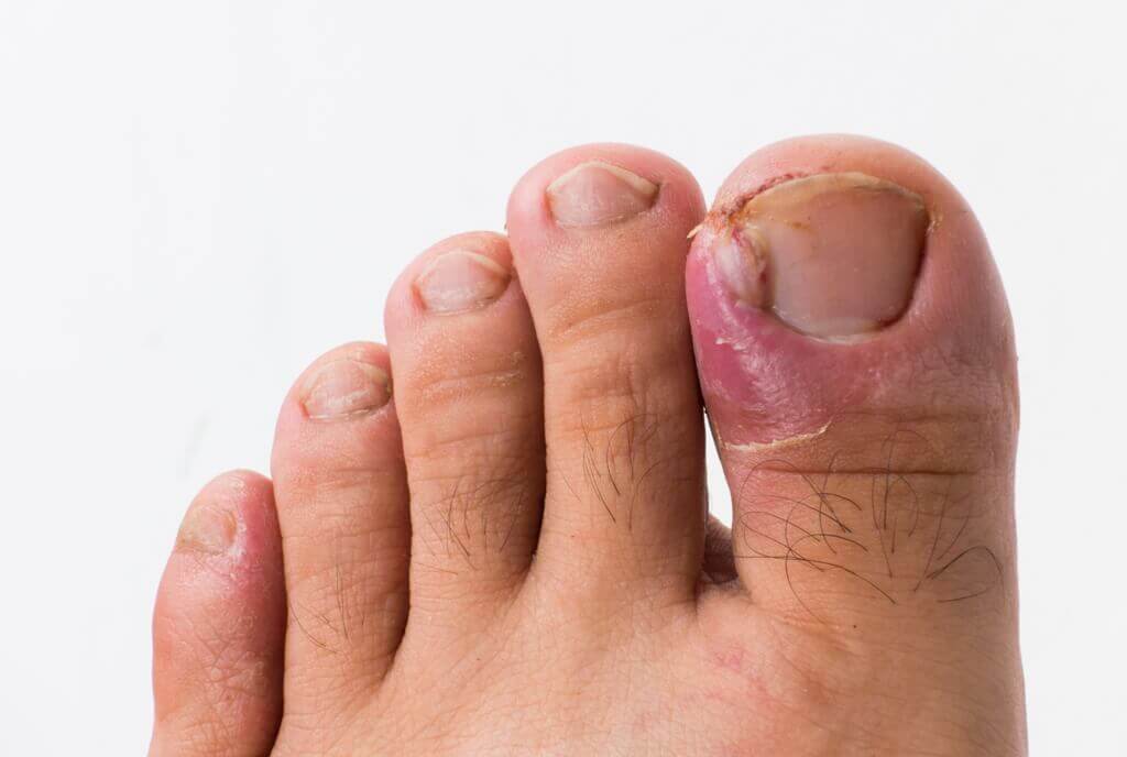 ingrown toenail